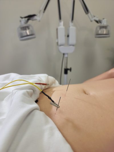 Electro-Acupuncture for Pain Relief - Advanced Women's Health Clinics