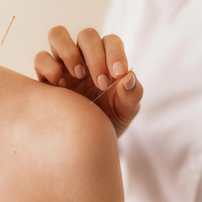 Acupuncture needles being placed into a person's shoulder